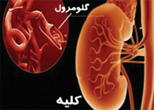 سندروم نفروتیك